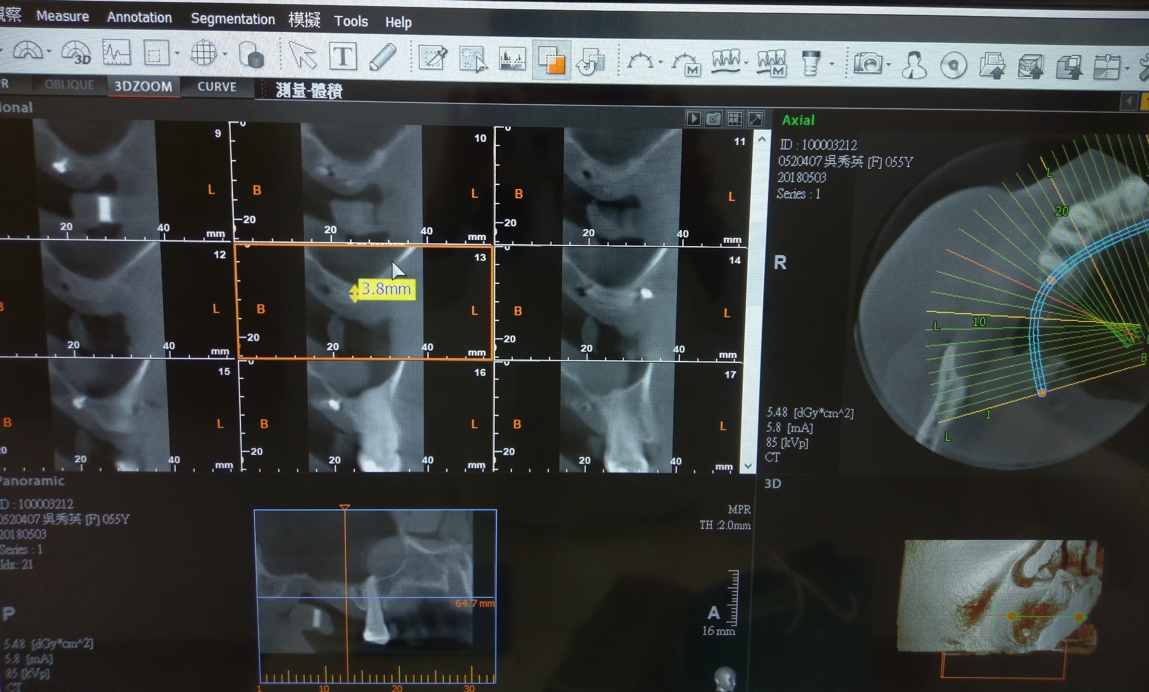植牙+鼻竇增高手術**一次完成