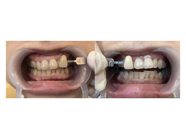 牙齒美白案例分享