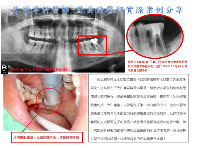 牙周病案例分享