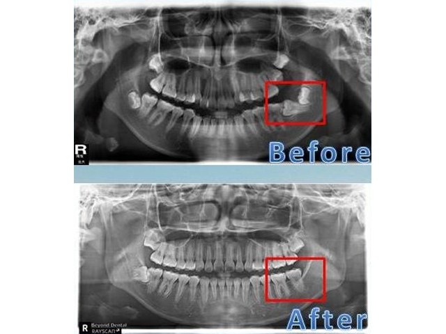 恢復自信笑容及咬合功能